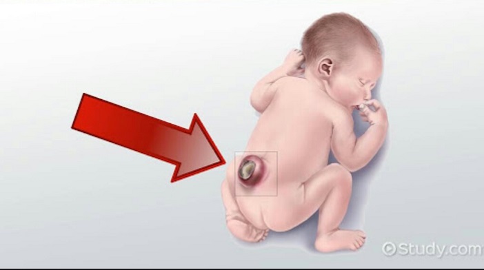 FOLIC ACID: A WAY OF REDUCING THE OCCURRENCE OF NEURAL TUBE DEFECTS (NTDs).