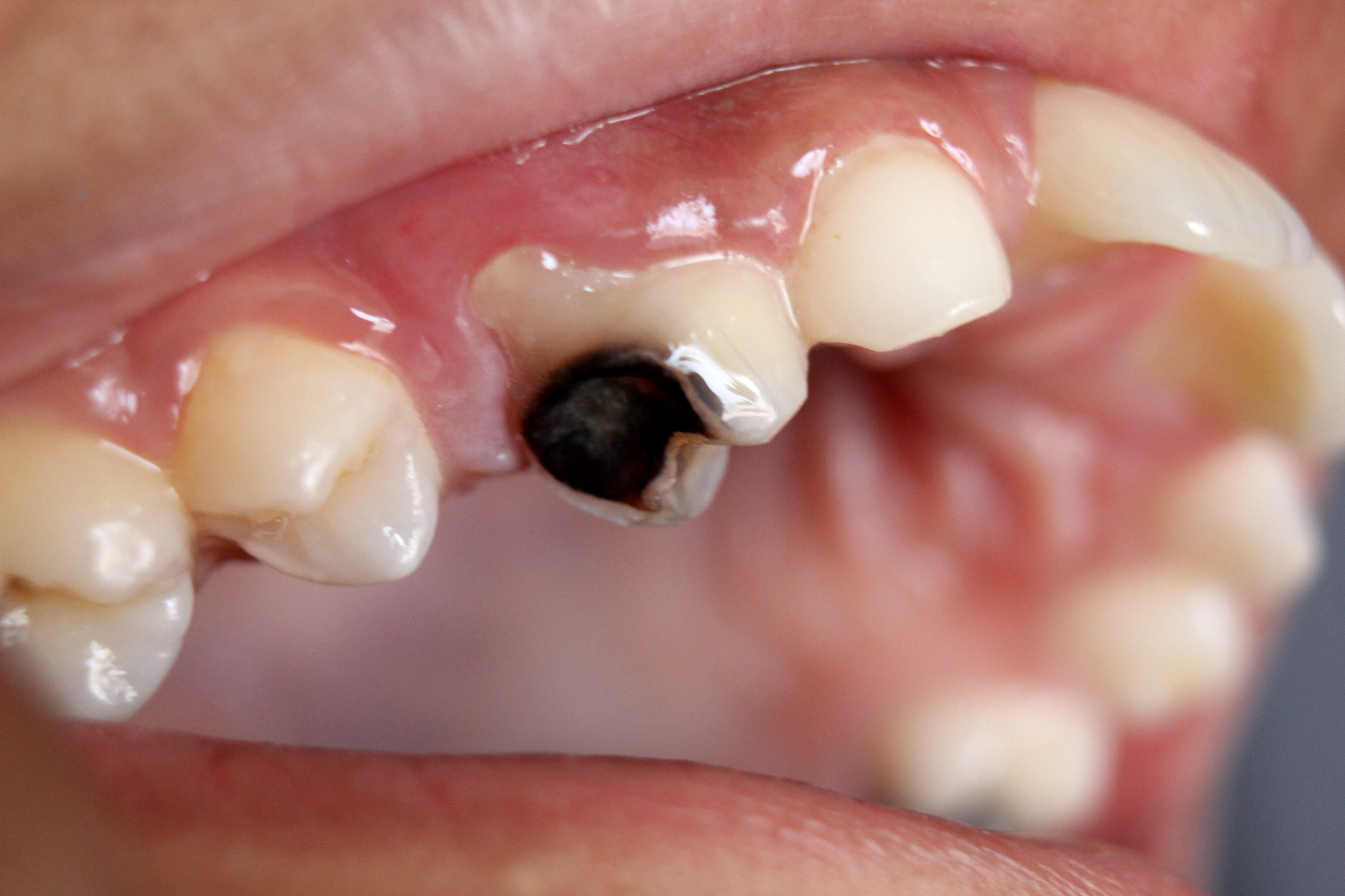 WHAT YOU NEED TO KNOW ABOUT DENTAL CARIES.