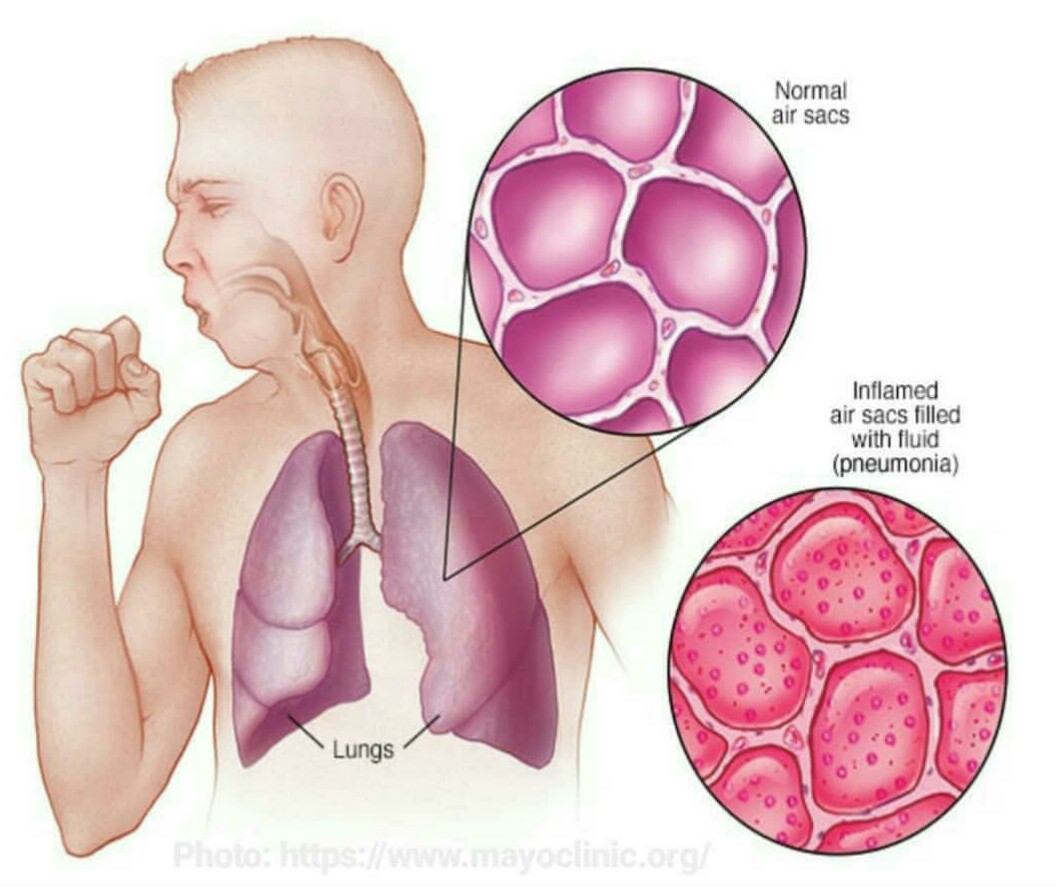 KNOW MORE ABOUT PNEUMONIA