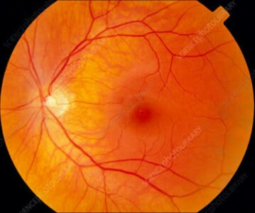 Diabetic Retinopathy in low resource settings and its challenges